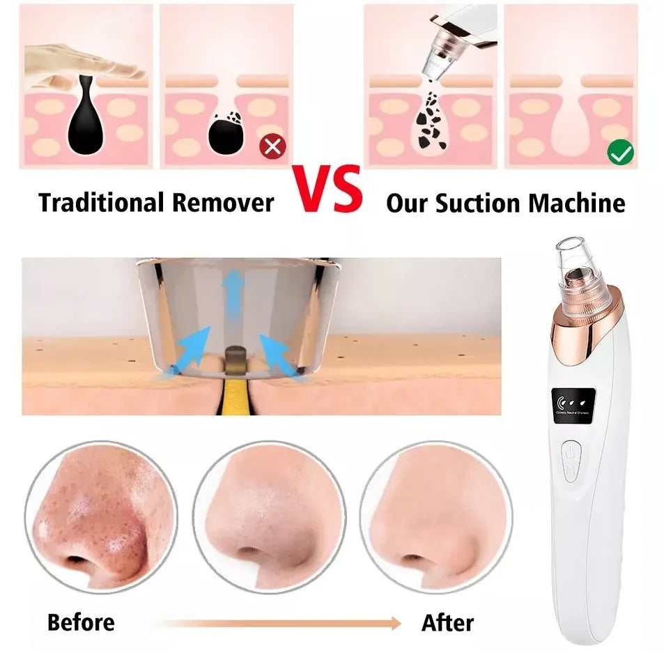 5in1 Blackhead Remover Machine